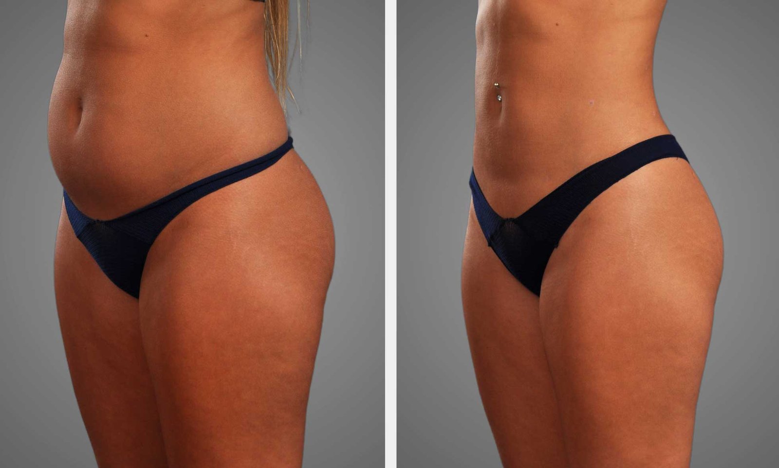 Body Contouring